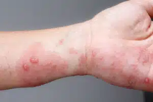 foto del polso e mano affetto da scabbia